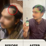 Hair Fall Control Oil + Derma Roller - Image 5